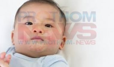 শিশুদের শরীরে র‌্যাশ নিরাময়ের উপায়