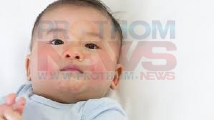 শিশুদের শরীরে র্যাশ নিরাময়ের উপায়