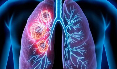 ফুসফুসে ক্যান্সার হতে পারে ৬ কারণে