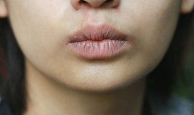 ঠোঁট ফাটার সমস্যা দূর করবেন যেভাবে