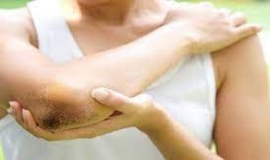 কনুইয়ের কালো দাগ দূর করার ৩ উপায়