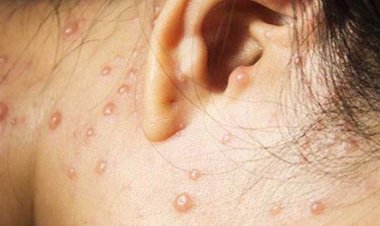 যেভাবে ছড়ায় জলবসন্ত, কী করবেন