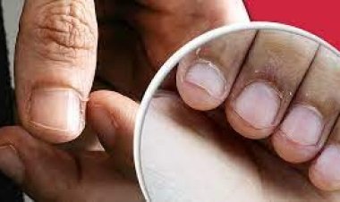 নখের পাশে চামড়া উঠলে দ্রুত যা করবেন