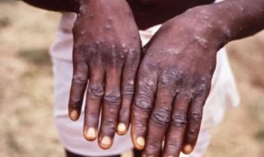 যুদ্ধ, করোনা ও মাঙ্কিপক্স নিয়ে বড় চ্যালেঞ্জের মুখে বিশ্ব