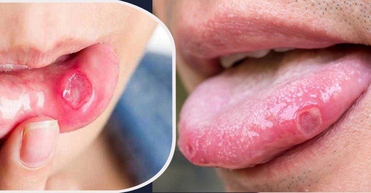 মুখের ঘা সারানোর ঘরোয়া ৫ উপায়