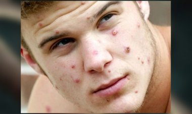 মাঙ্কিপক্স: বিশ্বব্যাপী জরুরি স্বাস্থ্য সতর্কতা জারি বিশ্ব স্বাস্থ্য সংস্থার