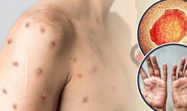 মাঙ্কিপক্স সংক্রমণের ঝুঁকি কাদের বেশি?