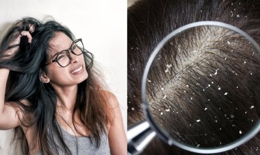 খুশকি দূর করার ঘরোয়া উপায়