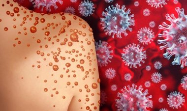 মাঙ্কিপক্সের নাম বদলে ‘ট্রাম্পের’ নামে রাখার প্রস্তাব