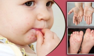 হ্যান্ড ফুট অ্যান্ড মাউথ রোগের প্রকোপ, আক্রান্ত হচ্ছে শিশুরা