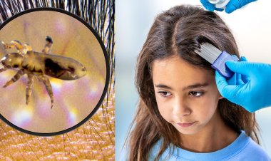 উকুন দূর করার ঘরোয়া উপায়