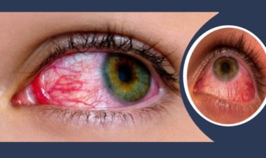  ঘরে ঘরে ‘চোখ ওঠা’ রোগ, আতঙ্কিত না হওয়ার পরামর্শ