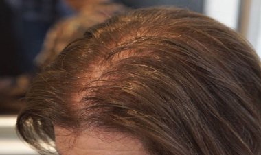 চুল পাতলা হওয়ার কারণ