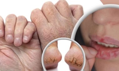 শীতে যে কারণে ফাটে ত্বক