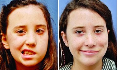 শীতে মুখ বেঁকে গেলে কী করবেন?