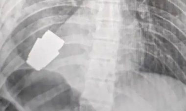 ইউক্রেনীয় সেনার বুক থেকে অবিস্ফোরিত গ্রেনেড অপসারণ