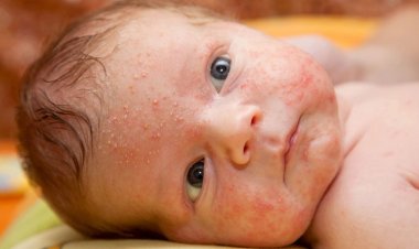 গরমে শিশুর হিট র‍্যাশ? সমাধান জেনে নিন