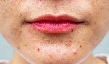 সূর্যালোকের চেয়েও ত্বকের ক্ষতি করে যেসব খাবার