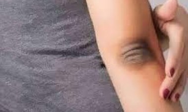 কনুইয়ের কালো দাগ দূর করতে কী করবেন