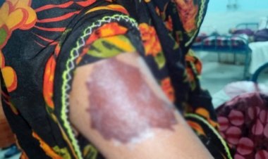 যৌতুক না পেয়ে গৃহবধূকে বৈদ্যুতিক ইস্ত্রি দিয়ে ছ্যাঁকা