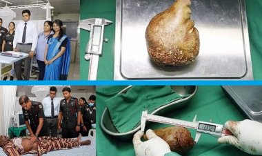 কিডনি থেকে সবচেয়ে বড় পাথর অপসারণের রেকর্ড
