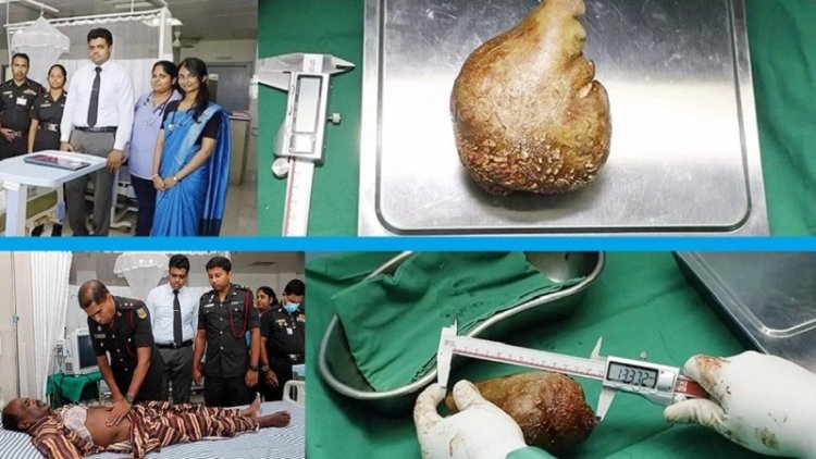 কিডনি থেকে সবচেয়ে বড় পাথর অপসারণের রেকর্ড