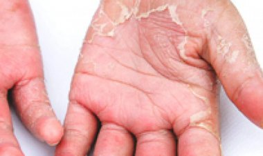 শীতকালে হাত ও পায়ের চামড়া ওঠলে যা করনীয়