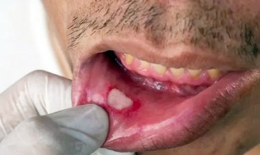 মুখে যে ৫ লক্ষণ দেখলে ধূমপায়ীরা সতর্ক হবেন