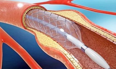 আলোচনার পরও হার্টের রিং বিক্রি বন্ধ, বিপাকে রোগীরা