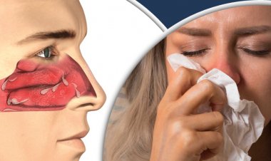 ঠান্ডায় নাক বন্ধভাব দূর করবেন যে উপায়ে