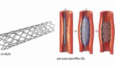 ফের বাড়ছে হার্টের রিংয়ের দাম