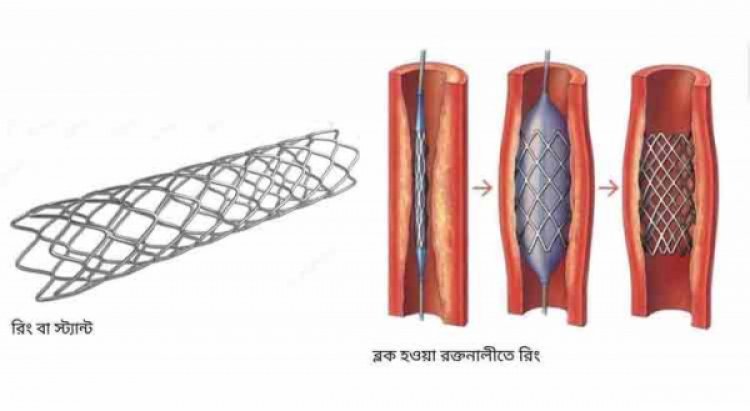 ফের বাড়ছে হার্টের রিংয়ের দাম