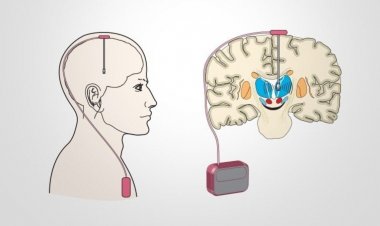 পারকিনসন্সের চিকিৎসায় 'ব্রেনসেন্স' প্রযুক্তি ব্যবহার করে যুগান্তকারী সাড়া