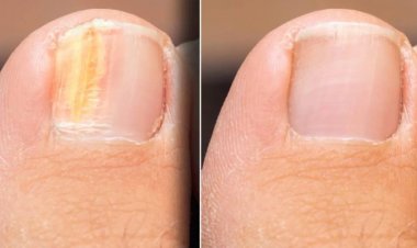 নখের রং ও গঠনে শরীরের অসুস্থতার সংকেত, জানুন গুরুত্বপূর্ণ লক্ষণ