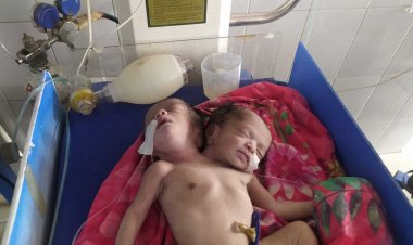 পঞ্চগড়ে কনজয়েনড টুইন শিশুর জন্ম